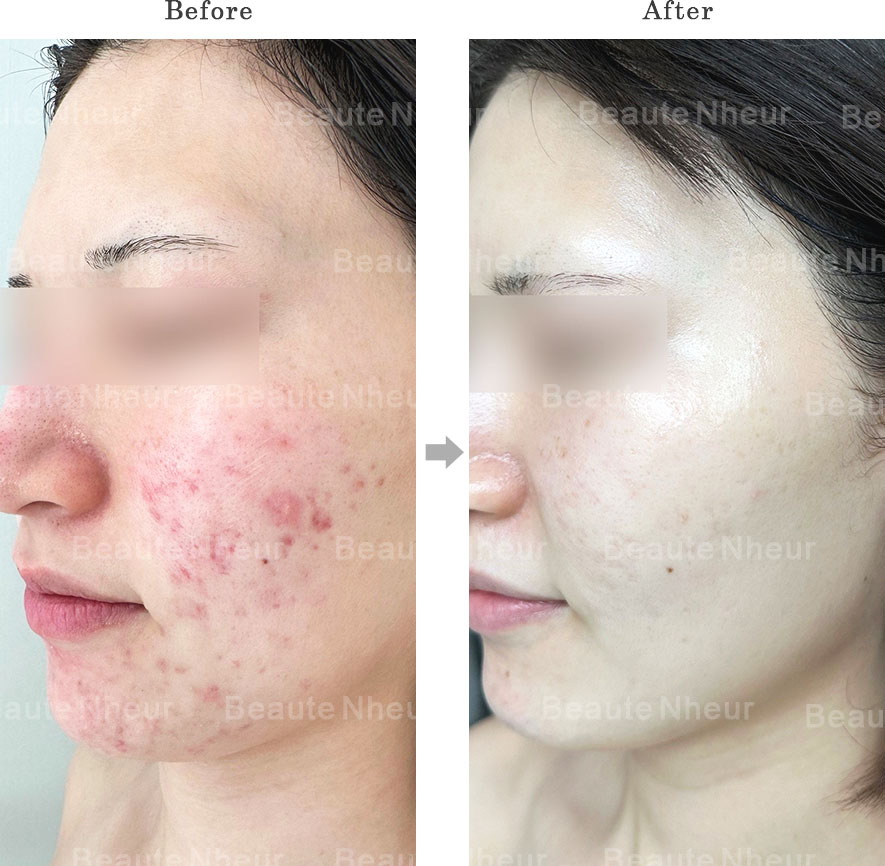 ニキビ 症例写真