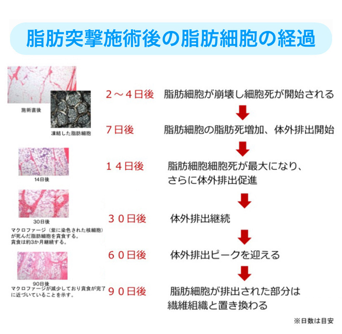 脂肪突撃施術後の脂肪細胞の経過